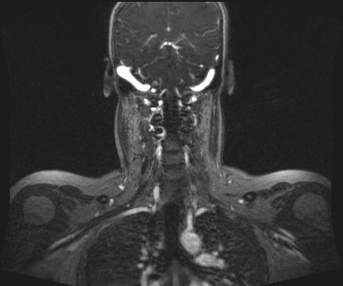 Carotid body tumor (Radiopaedia 12777-12912 MRA 46).jpg