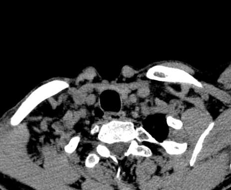 Carotid body tumor (Radiopaedia 61750-69757 Axial non-contrast 107).jpg