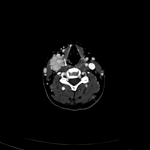 Carotid body tumor (Radiopaedia 83615-98727 D 71).jpg