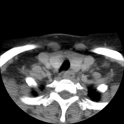Carotid body tumor (paraganglioma) (Radiopaedia 38586-40729 A 64).jpg