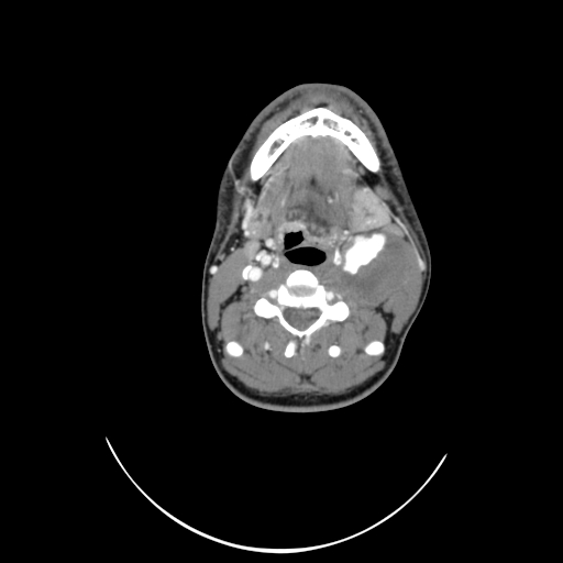 File:Carotid bulb pseudoaneurysm (Radiopaedia 57670-64616 A 32).jpg