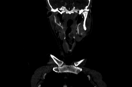 File:Carotid bulb pseudoaneurysm (Radiopaedia 57670-64616 D 5).jpg