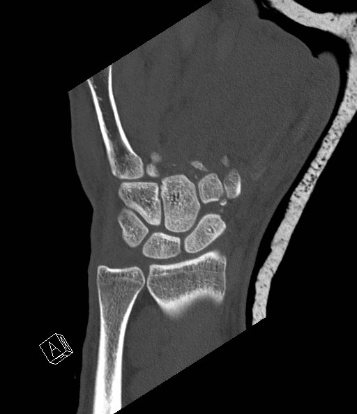 File:Carpal fractures (smart watch impaction) (Radiopaedia 55844-62430 Coronal bone window 12).jpg