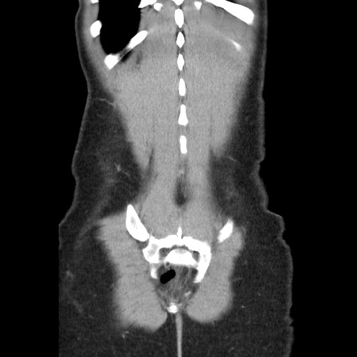 Castleman disease with fibrous pseudotumor in the abdomen (Radiopaedia 77296-89373 B 84).jpg