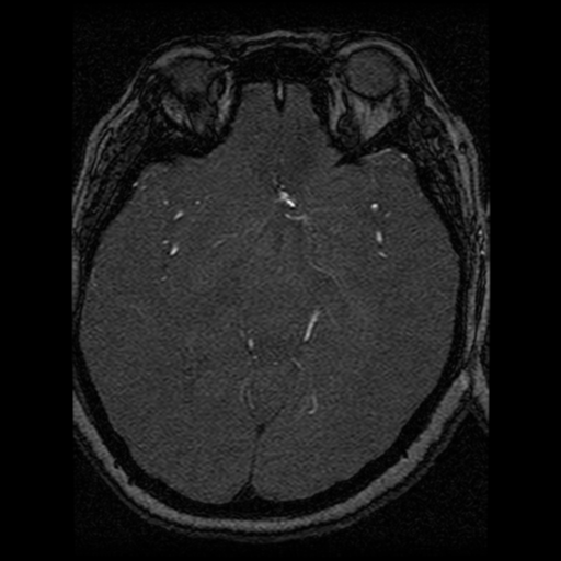 Cavernoma, DVA and right ICA aneurysm (Radiopaedia 33890-35072 E 41).png