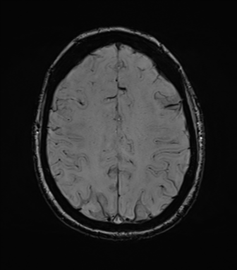 File:Cavernoma with bleed - midbrain (Radiopaedia 54546-60773 Axial SWI 35).png