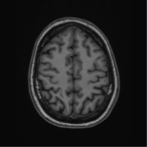 Cavernoma with bleed - midbrain (Radiopaedia 54546-60774 Axial T1 43).png