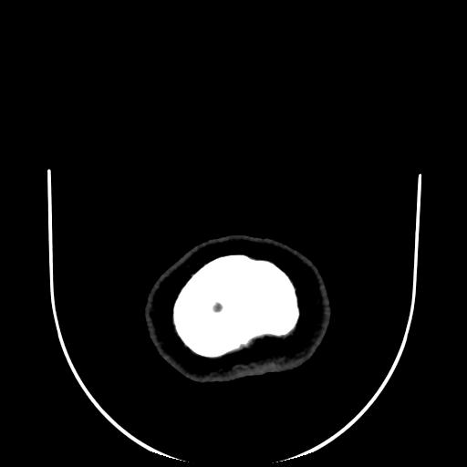 Cavernoma with developmental venous anomaly (Radiopaedia 22470-22506 C 205).jpg