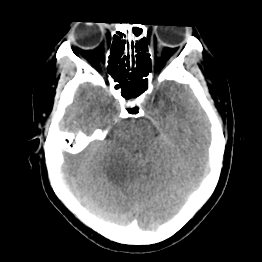 Cavernoma with hemorrhage (Radiopaedia 70755-80931 Axial non-contrast 18).png