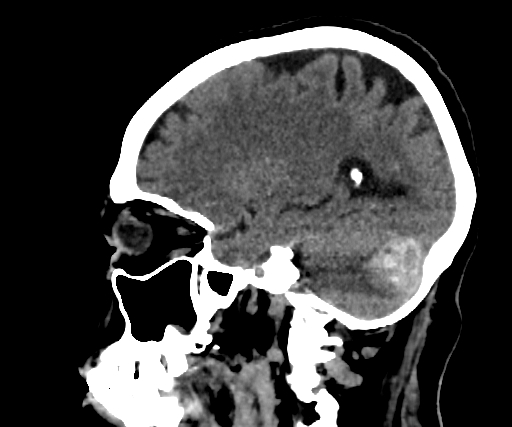 Cavernous hemangioma of the cerebellar falx (Radiopaedia 73025-83723 B 113).jpg