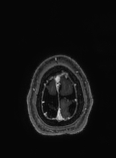 File:Cavernous hemangioma of the cerebellar falx (Radiopaedia 73025-83724 Axial T1 C+ 28).jpg