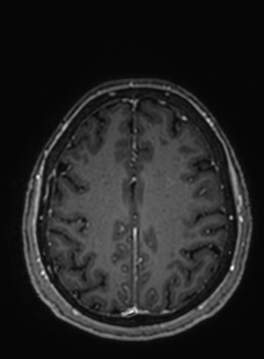 Cavernous hemangioma of the cerebellar falx (Radiopaedia 73025-83724 Axial T1 C+ 99).jpg
