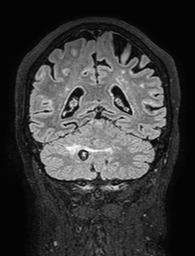 Cavernous hemangioma of the cerebellar falx (Radiopaedia 73025-83724 Coronal FLAIR 248).jpg