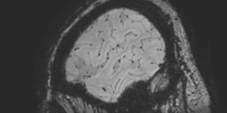 Cavernous hemangioma of the cerebellar falx (Radiopaedia 73025-83724 Sagittal BOLD 181).jpg