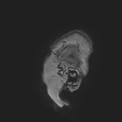 File:Cavernous hemangioma of the cerebellar falx (Radiopaedia 73025-83724 Sagittal T1 3).jpg