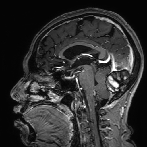 File:Cavernous hemangioma of the cerebellar falx (Radiopaedia 73025-83724 Sagittal T1 C+ 104).jpg