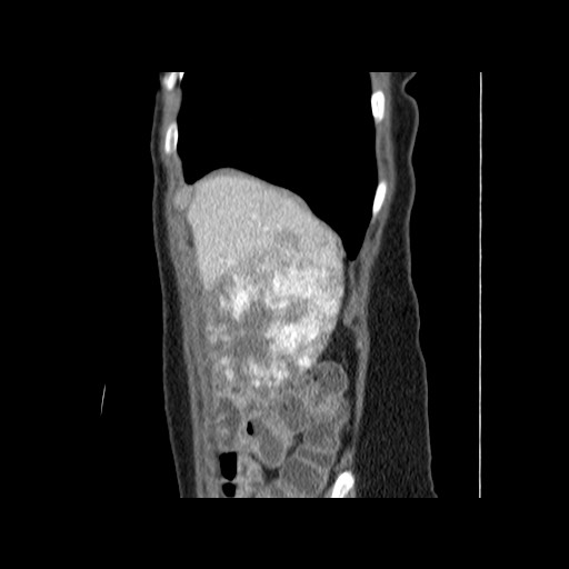 Cavernous hepatic hemangioma (Radiopaedia 75441-86667 D 22).jpg