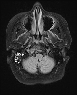 File:Cavernous sinus meningioma (Radiopaedia 63682-72367 Axial FLAIR 4).jpg