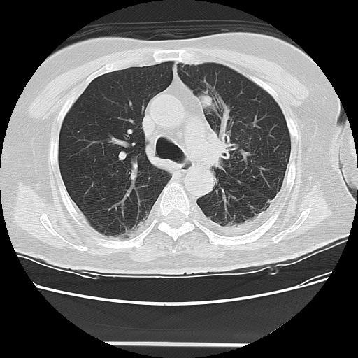 Cavitating pulmonary metastases (Radiopaedia 89545-106544 Axial lung window 22).jpg