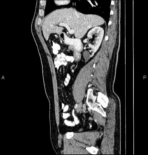 Cecal adenocarcinoma (Radiopaedia 85324-100916 E 33).jpg