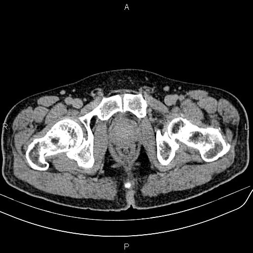 File:Cecal cancer with appendiceal mucocele (Radiopaedia 91080-108651 Axial C+ delayed 85).jpg