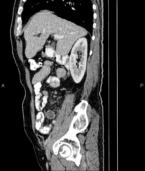 File:Cecal cancer with appendiceal mucocele (Radiopaedia 91080-108651 E 30).jpg