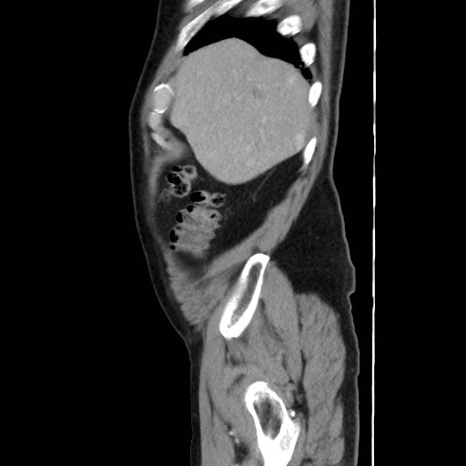 Cecal mass causing appendicitis (Radiopaedia 59207-66531 C 9).jpg