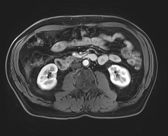 Cecal mass causing appendicitis (Radiopaedia 59207-66532 H 69).jpg