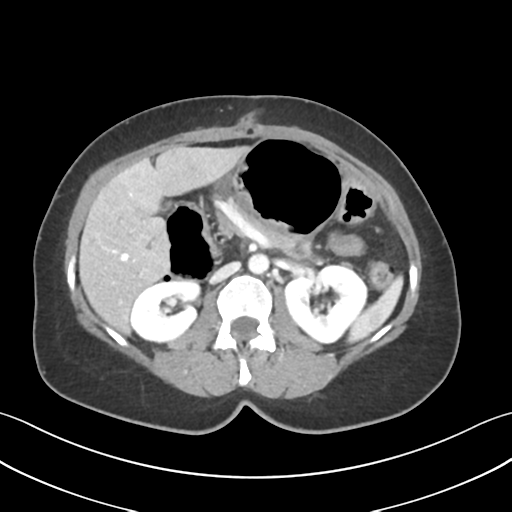 Cecum hernia through the foramen of Winslow (Radiopaedia 46634-51112 A 27).png