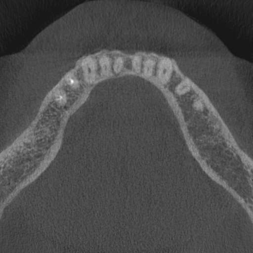 Cemento-osseous dysplasia (Radiopaedia 48251-53126 Axial non-contrast 31).jpg