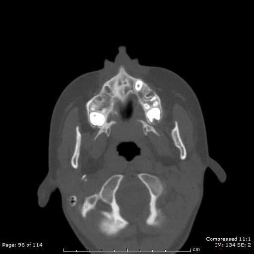 File:Central giant cell granuloma (Radiopaedia 45612-49754 Axial bone window 48).jpg