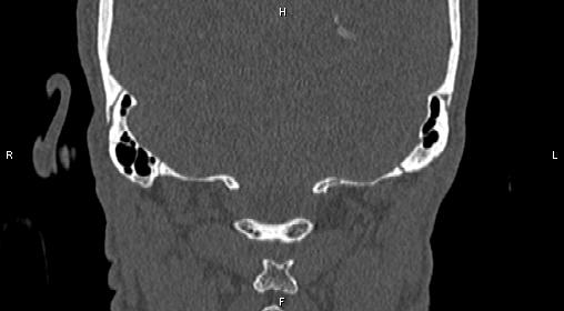 File:Central giant cell granuloma (Radiopaedia 83346-97761 Coronal bone window 42).jpg