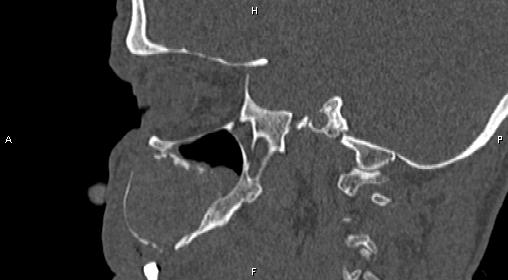 File:Central giant cell granuloma (Radiopaedia 83346-97761 Sagittal bone window 17).jpg