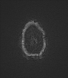 Central neurocytoma (Radiopaedia 84497-99872 Axial SWI 69).jpg