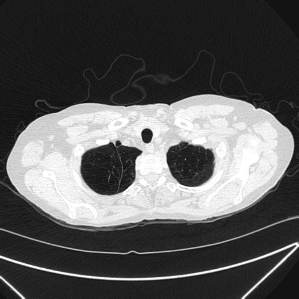 Centrilobular pulmonary emphysema (Radiopaedia 24495-24789 Axial lung window 7).jpg