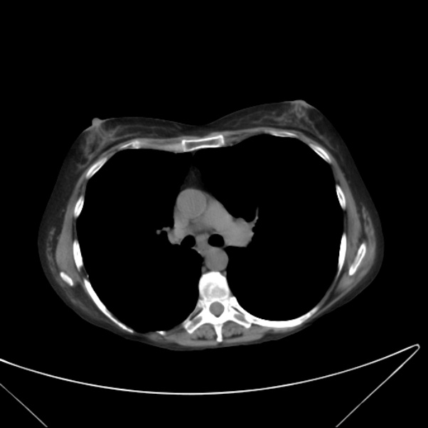 Centrilobular pulmonary emphysema (Radiopaedia 24495-24789 Axial non-contrast 22).jpg