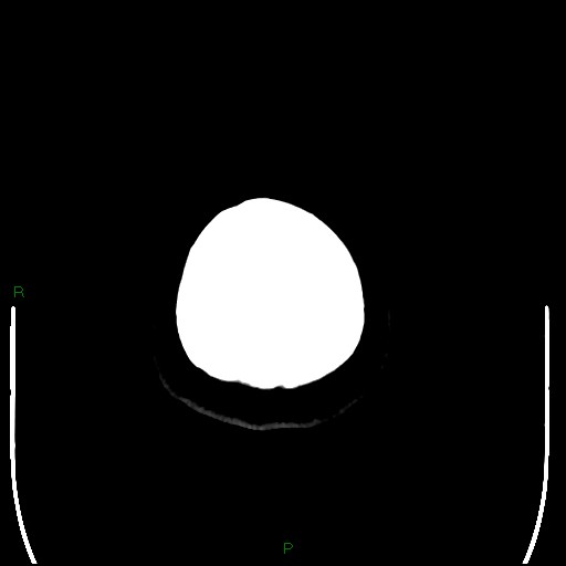 Cerebellar abscess (Radiopaedia 78135-90671 Axial non-contrast 111).jpg