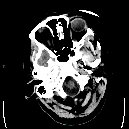 Cerebellar abscess (Radiopaedia 78135-90671 Axial non-contrast 14).jpg