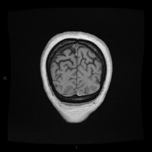 Cerebellar abscess (Radiopaedia 78135-90678 Coronal T1 C+ 156).jpg