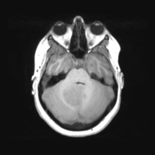File:Cerebellar ependymoma complicated by post-operative subdural hematoma (Radiopaedia 83322-97736 Axial T1 14).png