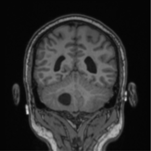 File:Cerebellar hemangioblastomas and pituitary adenoma (Radiopaedia 85490-101176 Coronal T1 32).png