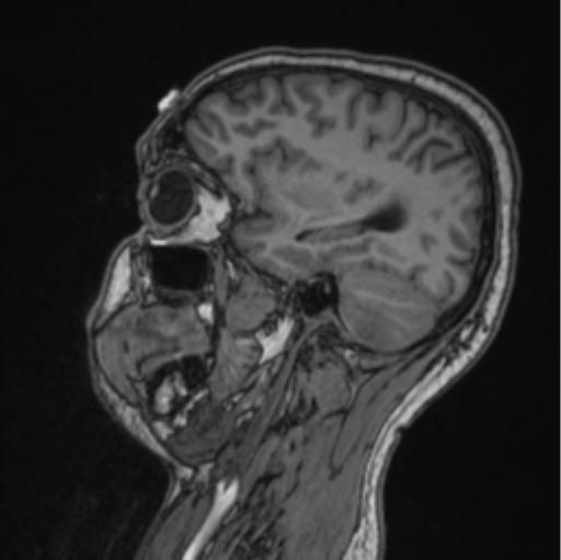 Cerebellar hemangioblastomas and pituitary adenoma (Radiopaedia 85490-101176 Sagittal T1 38).png