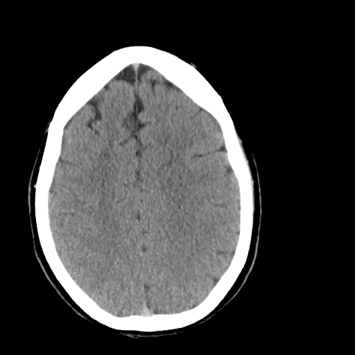 File:Cerebellar infarct due to vertebral artery dissection with posterior fossa decompression (Radiopaedia 82779-97029 Axial non-contrast 20).png
