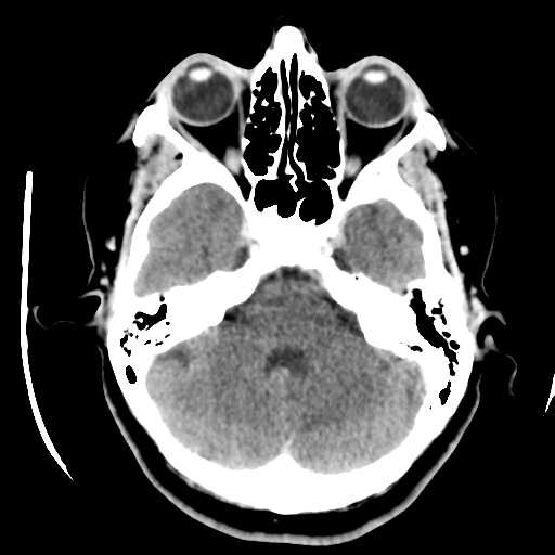Cerebellar metastasis (cystic appearance) (Radiopaedia 41395-44258 B 14).png