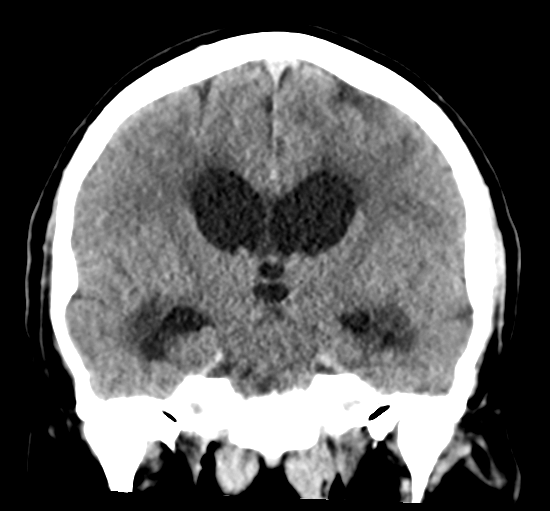 File:Cerebellar metastasis from lung adenocarcinoma (Radiopaedia 86690-102828 Coronal non-contrast 20).png