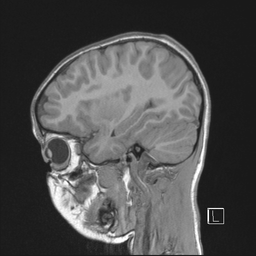 File:Cerebellar stroke (Radiopaedia 32202-33150 Sagittal T1 C+ 15).png