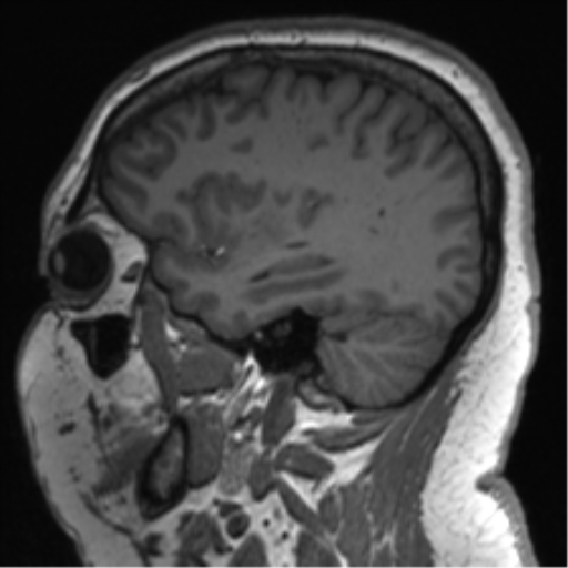 Cerebellopontine angle meningioma (Radiopaedia 48434-53348 Sagittal T1 65).png