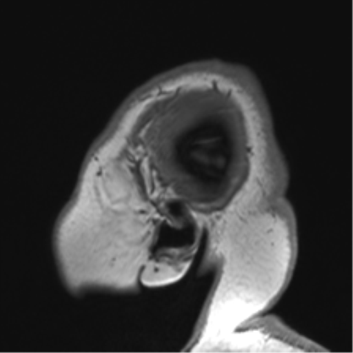 Cerebellopontine angle meningioma (Radiopaedia 48434-53348 Sagittal T1 9).png