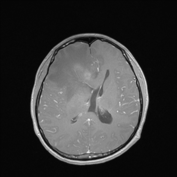 Cerebral abscess (Radiopaedia 24212-24478 Axial T1 C+ 36).jpg