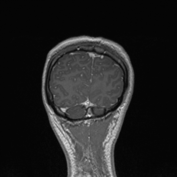 File:Cerebral abscess (Radiopaedia 24212-24478 Coronal T1 C+ 176).jpg